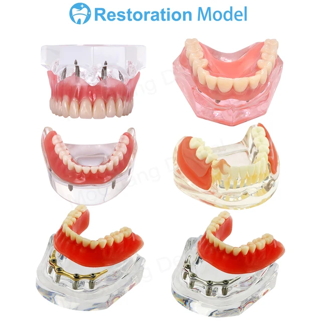 Dental Teaching Model Typodont | Teeth Implant & Pathology Study | Pink Gum M2001 - View #6