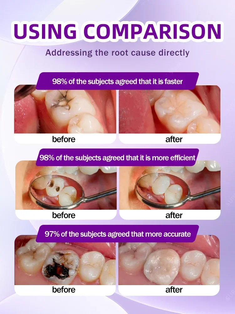 Anti Caries Repairing Cavities Tooth Decay Repair