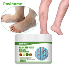 

Varicose Veins Relief Cream Vasculitis Phlebitis Spider Leg Pain Relief Ointment Herbal Medical Plaster Body Health Care 30g
