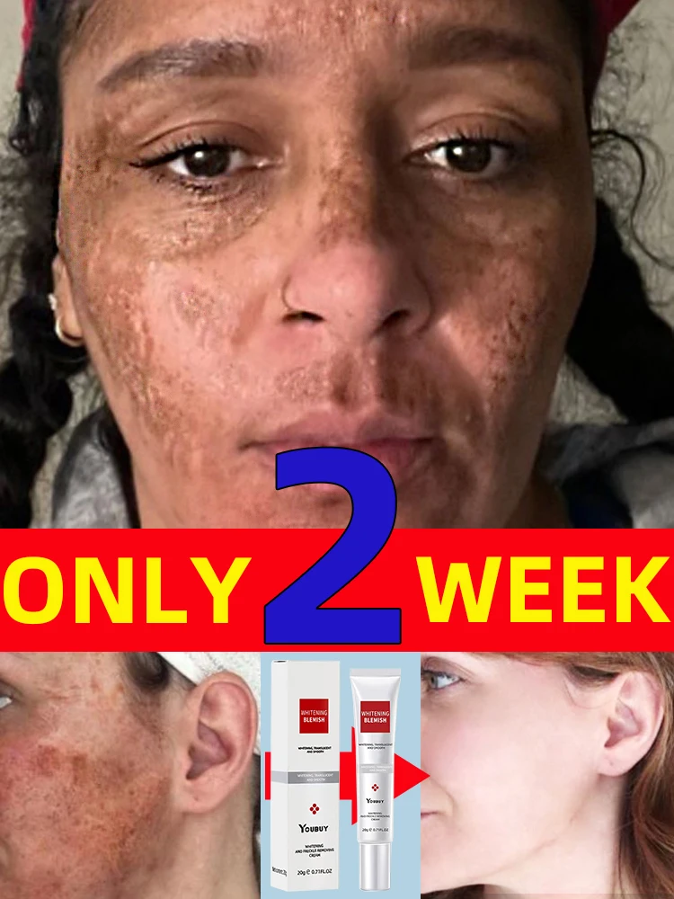 

Dark Spot Remover for Face Freckle Removal Cream Chloasma Remove Age Spots