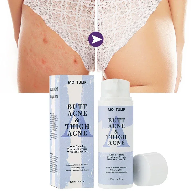 

100ml Butt Acne Treatment Cream Deep Clearing Buttocks Thigh Area Acne Pimples Zits Razor Bumps Dark Spot Smooth Body Skin Care