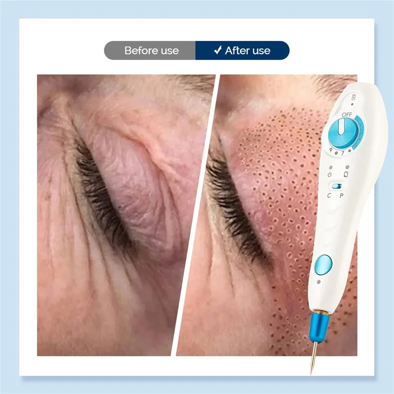 Fibroblast Original Plamax Cold Plasma Wireless Skin Tightly Acne Treatment Dark Age Skin Tag Blemish Removal Beauty Device 3