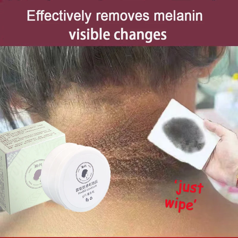

Anti Acanthosis Nigricans Whitening Cream Remove Melanin Armpit Elbow Private Care Products Body Butt Black Sitting Print Remove