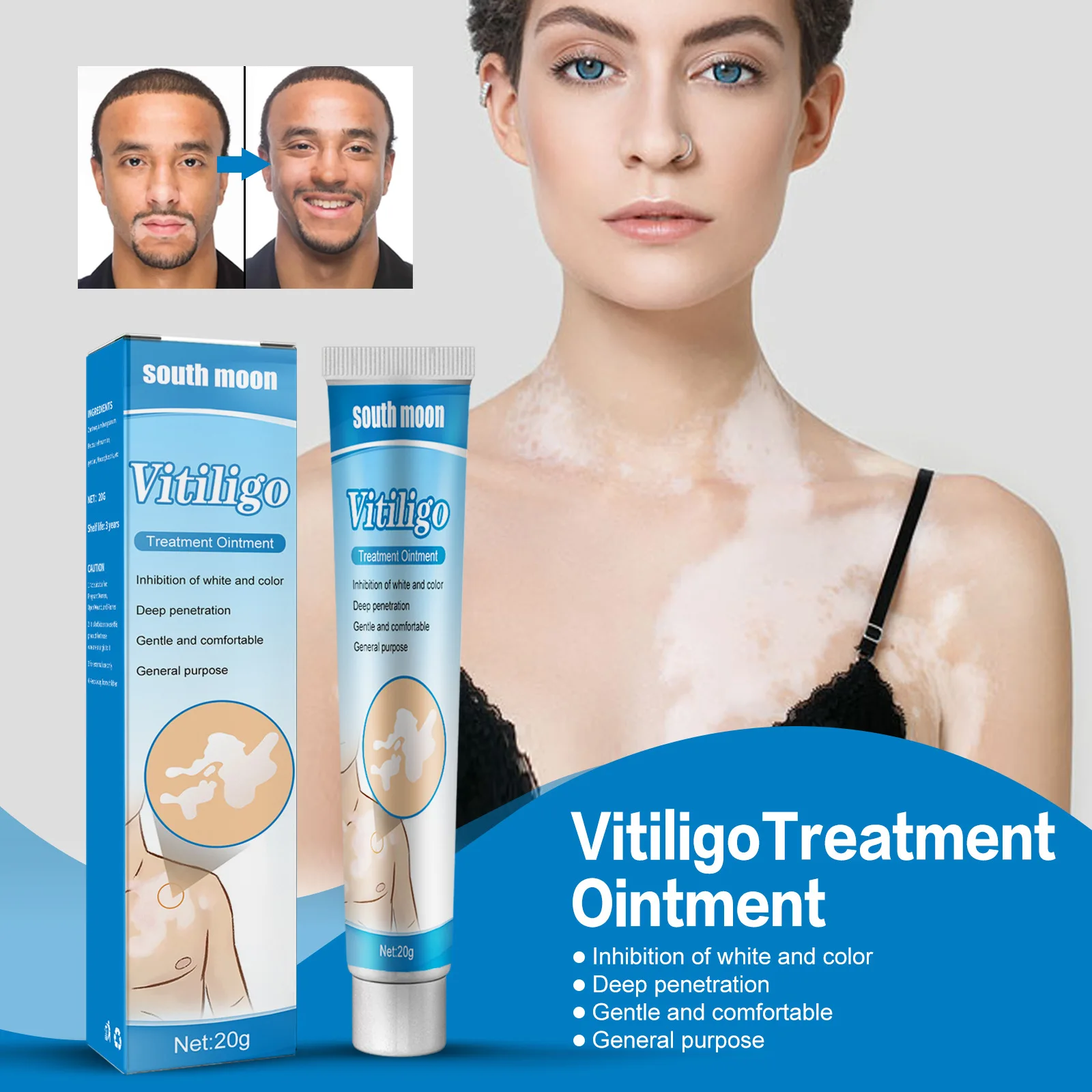 

20g Herbal Extract Vitiligo Ointment Remove Ringworm White Spot Removal Skin White Spot Leukoplakia Disease Treatment Cream