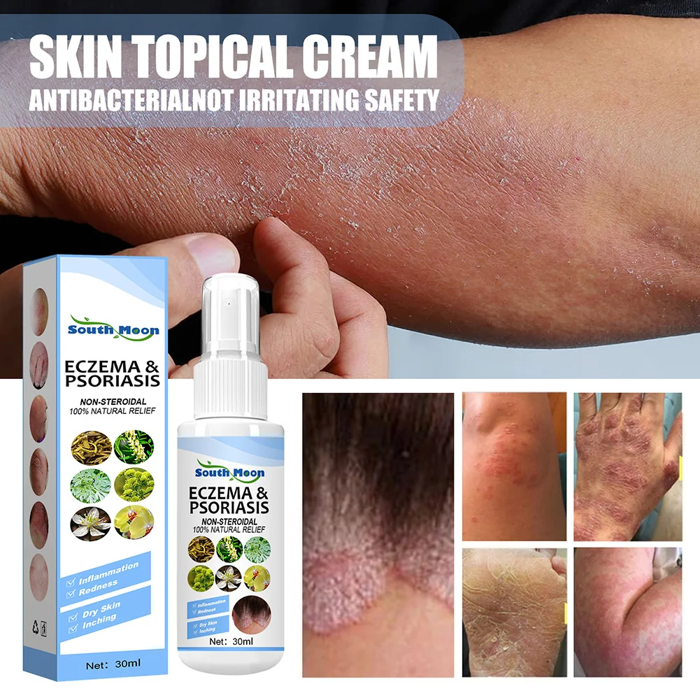 30ml Skin Psoriasis Spray Natural Herb Eczema Treatment Spray Itch Relief Improve Redness Dermatitis Psoriasis Health Care