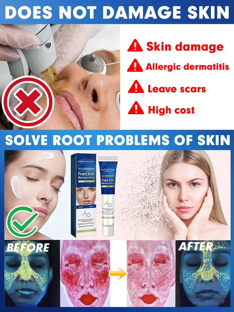 Dark Spot Remover For Face Black Spot Sun Melasma Chloasma Age Spots Sunburn Removal cream