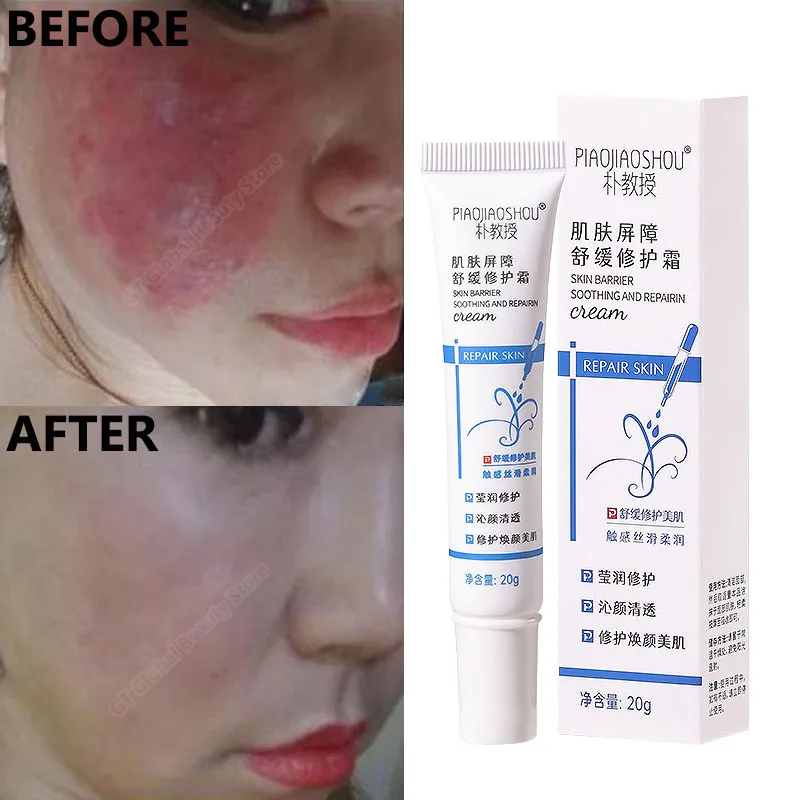 

Instant Repair Facial Redness Cream Red Blood Itching Treatment Anti Aging Rosacea Skin Moisturize Sooth Face Whiten Skin Care