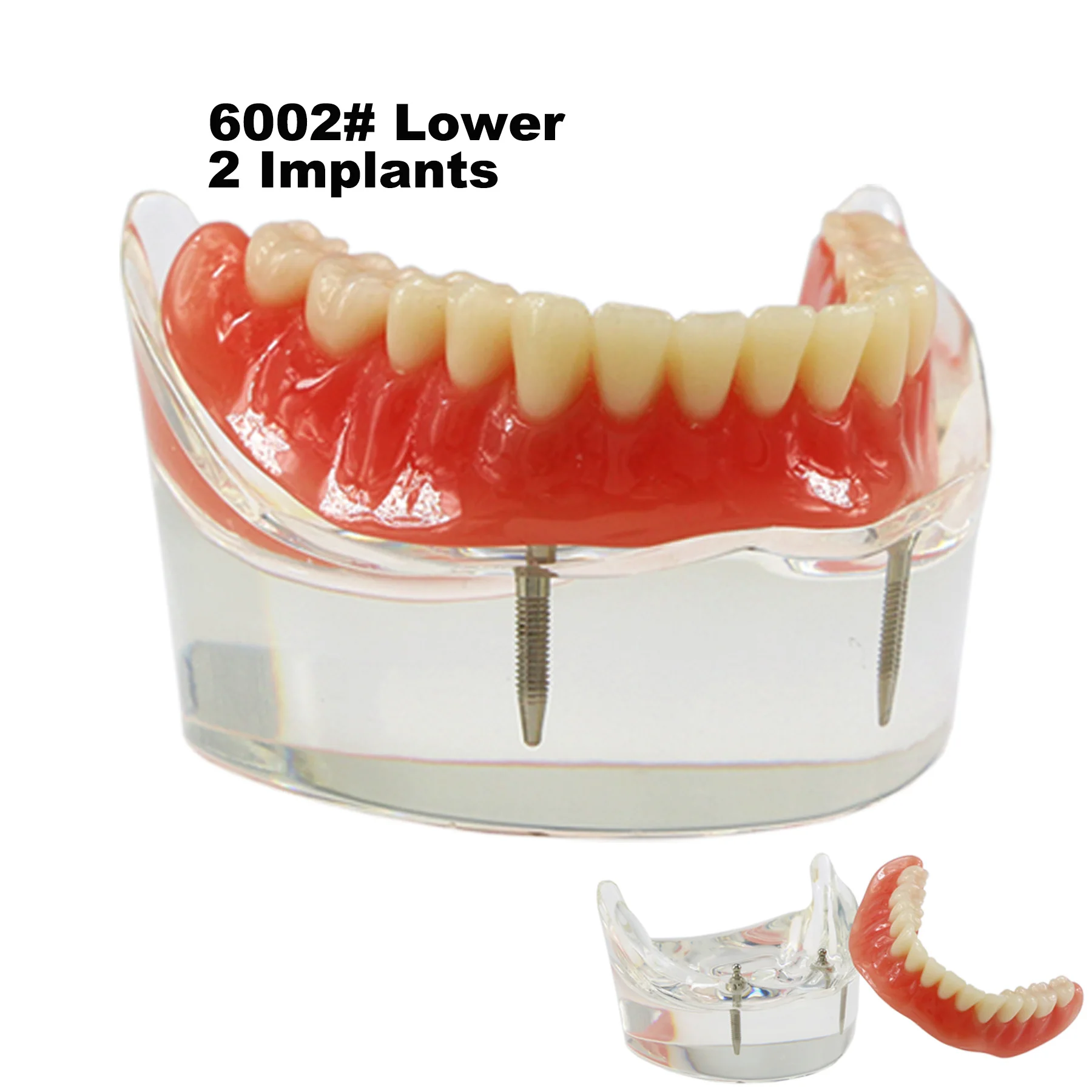 

Dental Implant Teeth Model M6002 Typodont Overdenture 2 Implants Lower inferior Restoration Demo For Study Teach