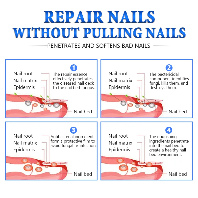 Jemeesen Fungus Removal Serum Gel Anti Infection Paronychia Onychomycos Nail Fungal Treatment Feet Care Essence Repair Nail Oil For Nail Fungus Remover