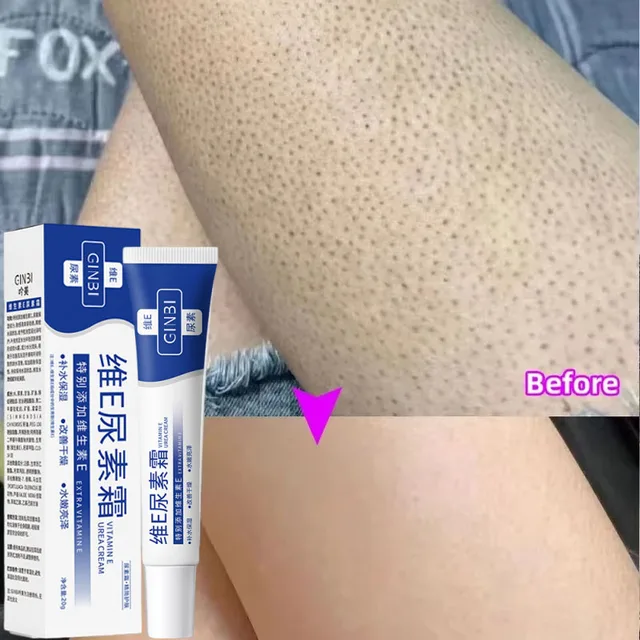 Keratosis Pilaris Cream – Smooth & Clear Skin