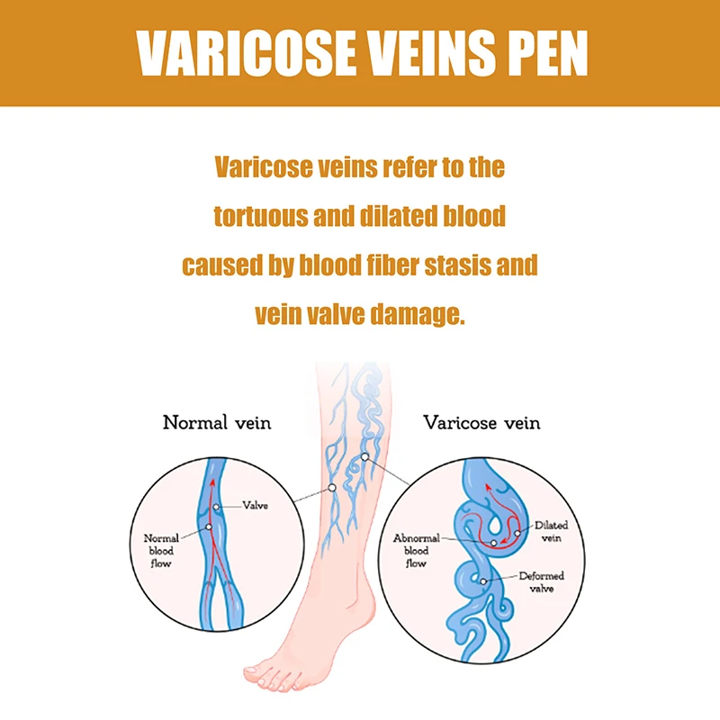 Lampshade Therapy Leg Repair Pen  Improving Blood Circulation Varicose Veins Relieves Leg Bulge Discomfort Pen Skin Care Product 4