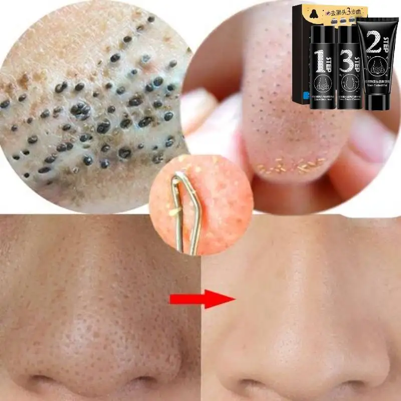 

Peel-Off Mask Blackhead & Acne Removal Treat Face Pores Shrink Oil Control Whiten Gel Skin Care Black Dots Essences Cream