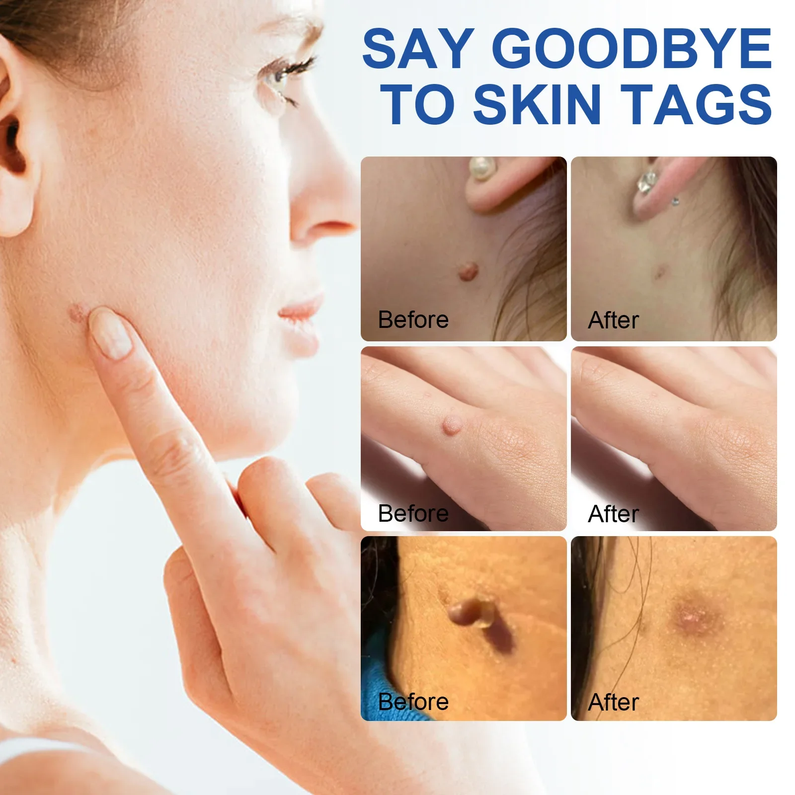 Painless Mole Removal Tool Kit for Facial Skin Care