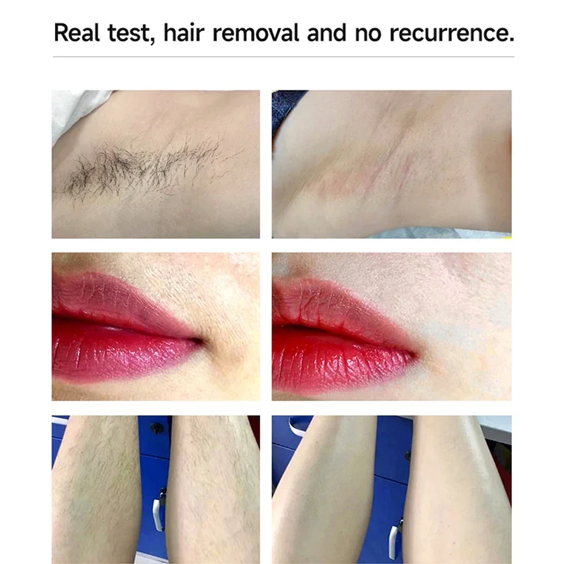 عدسات إزالة الشعر بالليزر MLAY T14 للاستخدام المنزلي ، مصباح إزالة الشعر IPL ، تجديد شباب الجلد ، إزالة حب الشباب ، عدسات وجه بيكيني ، ICE