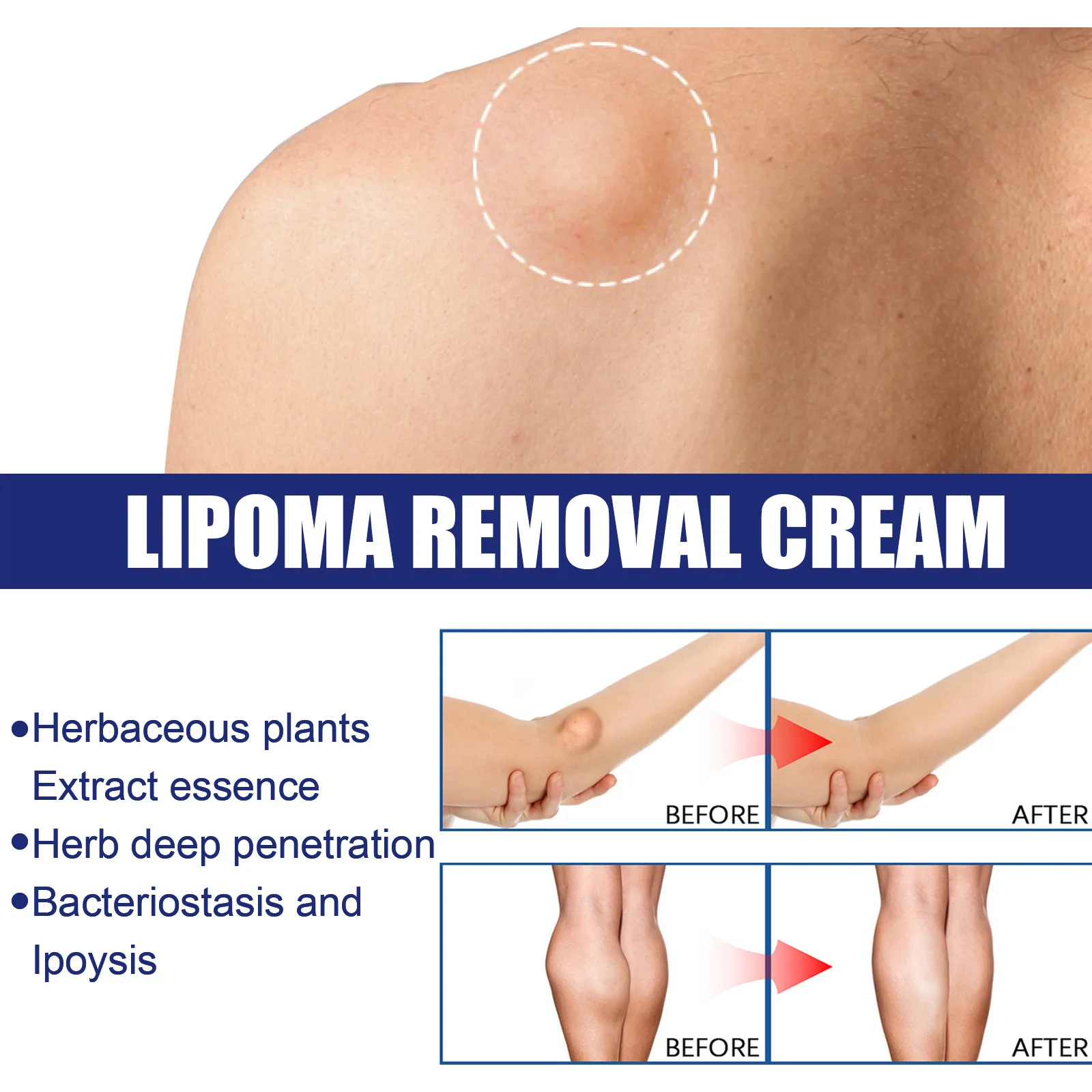 Anti-Tumor Ointment Fat Soluble Mass Subcutaneous Lump Treatment Anti-Adipose Tissue Hyperplasia Swelling Fibroma Removal Cream