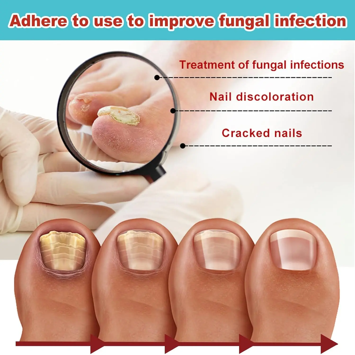 16PCS Foot Nail Repair Patch Grey Fungal Nail Thicken Soft Paronychia Infection Hand Correction Sticker Ingrown Toenail