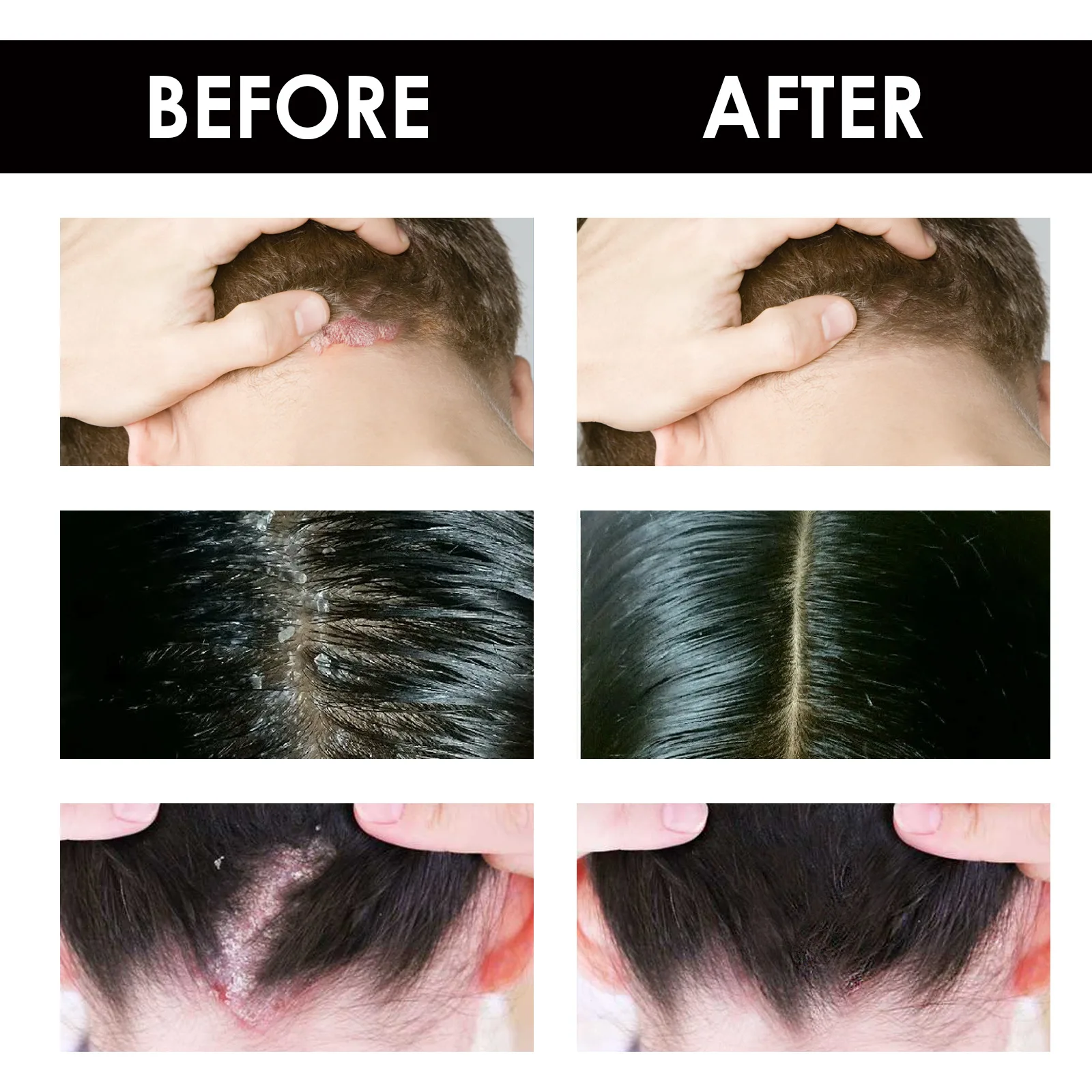 كريم الجلد الدهني ، وحب الشباب وحكة الرأس وفروة ال...