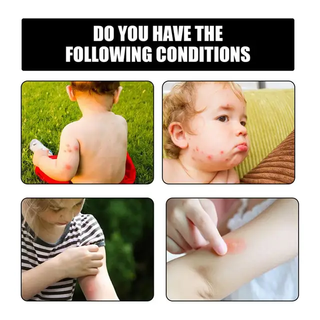 30 Ml-Es Szúnyogtaszító Spray-Szúnyog Antipruritikus Folyékony Kültéri Kemping Szúnyogok Taszító Anti-Rovarcsípések Spray - Image 4