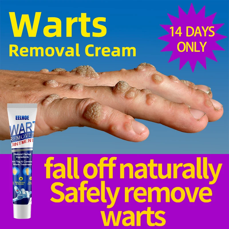 Skin Tag Removal Cream Flat Wart Genital Warts Filiform Wart Plantar skin-tag-removal-cream-flat-wart-genital-warts-filiform-wart-plantar