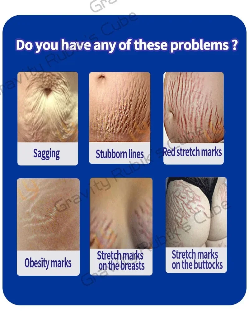 Description Picture 3 of itemStretch Mark Permanent Remover cream Removal Cream White Stretch Mark Remover Stretch Mark Remover