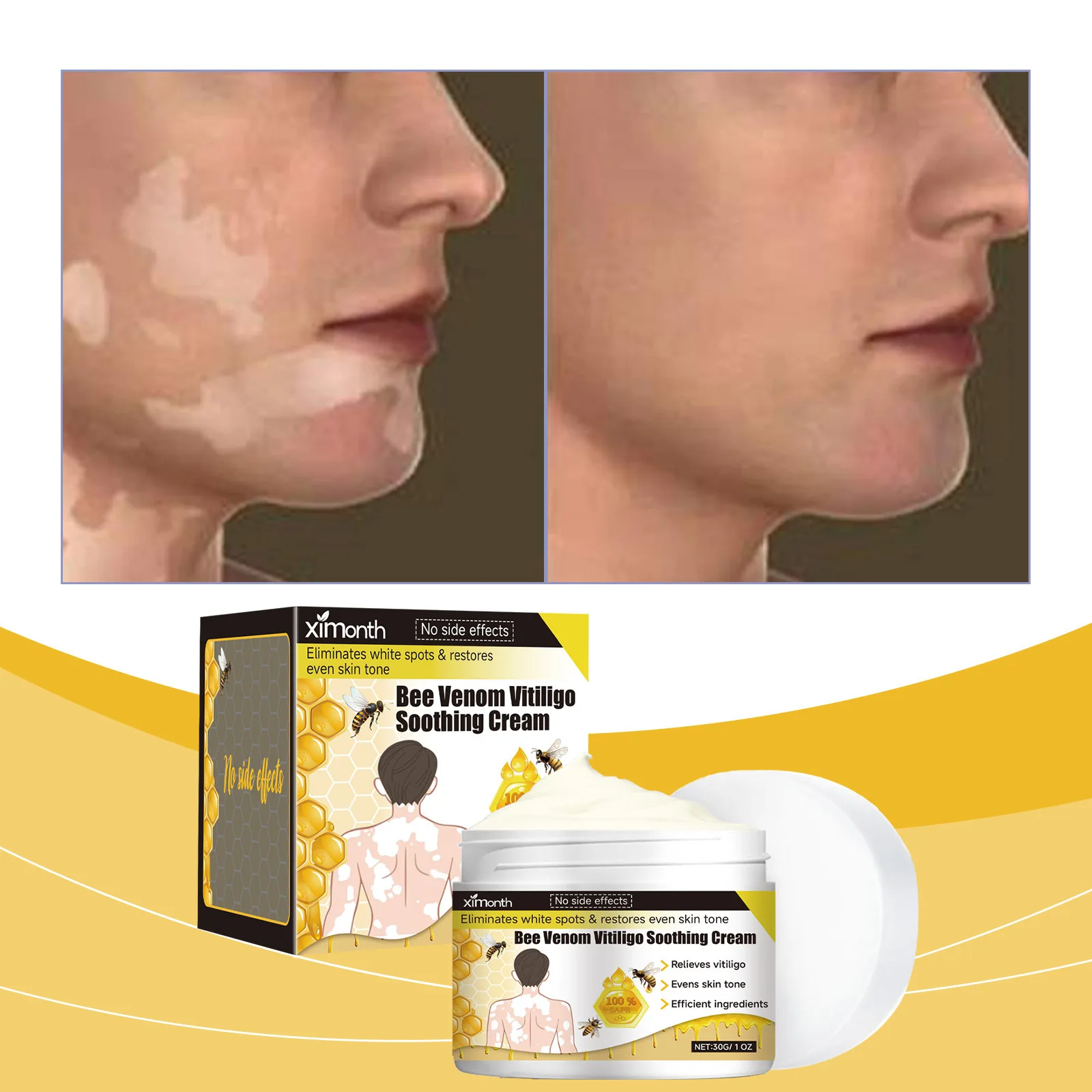 Bee Venom Vitiligo Soothing Cream Reament Repair Leukoplakia Reduce Pigment Melanin Antibacterial Moisturing Skin Care Cream