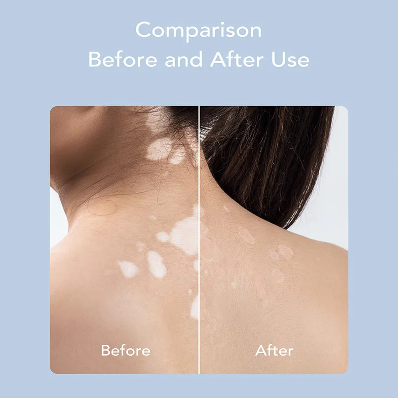 UVB Ultraviolet Phototherapy 308NM Narrowband Ultraviolet Lamp LaserUVB Treatment Anti Vitiligo Psoriasis White Spot Skin