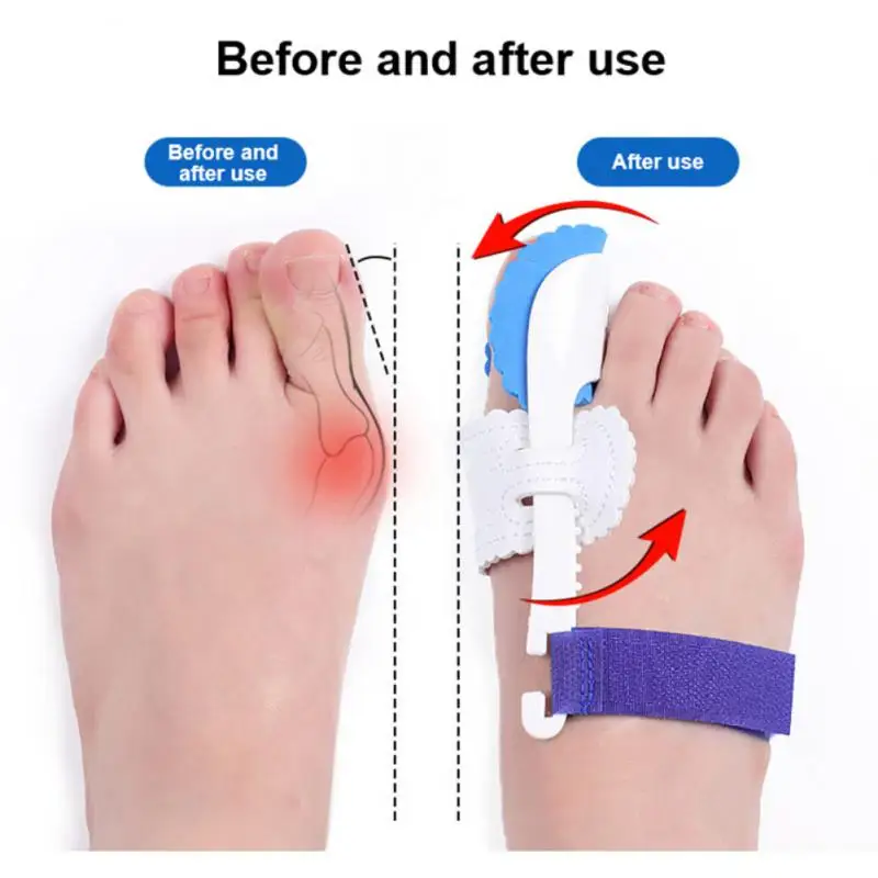 

Bone Toe Bunion Splint Straightener Corrector Pain Relief Hallux Valgus Correction Thumb Protector Foot Care Tools