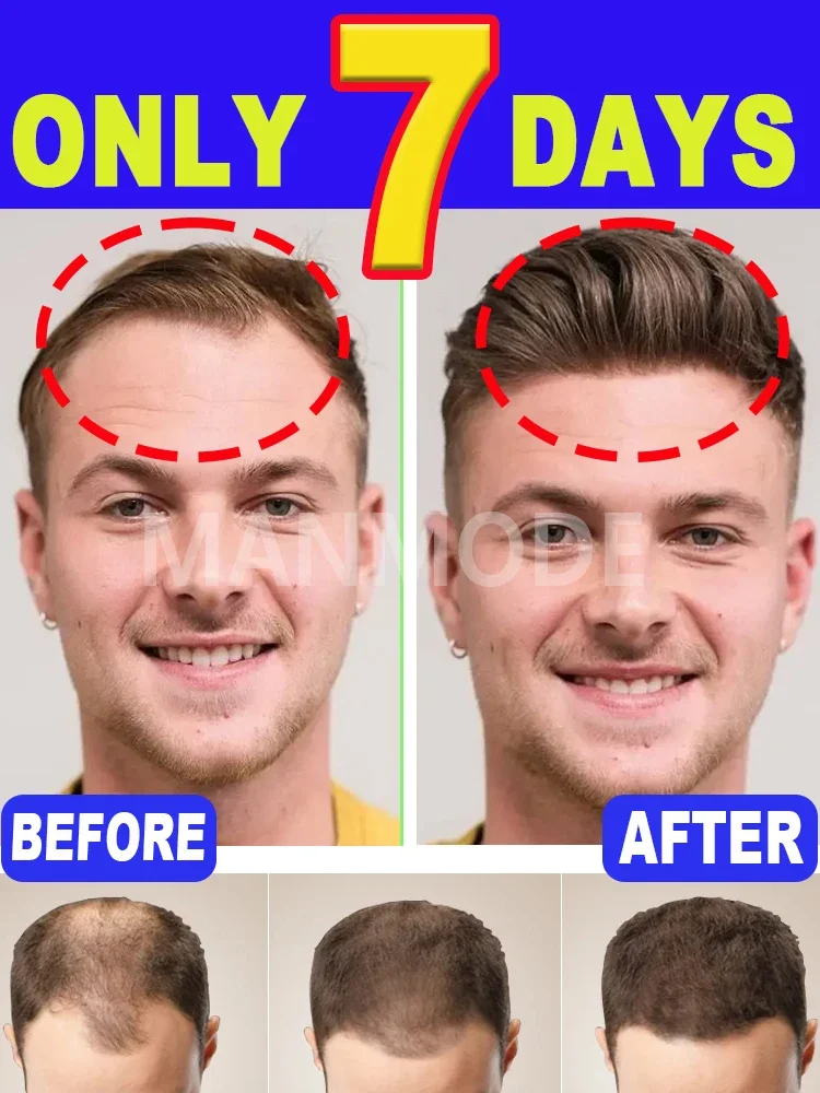 Best-selling Hair Growth Products Anti-Hair Loss Hair Growth Serum for Men and Women Fast Hair Growth Oil 100% Natural