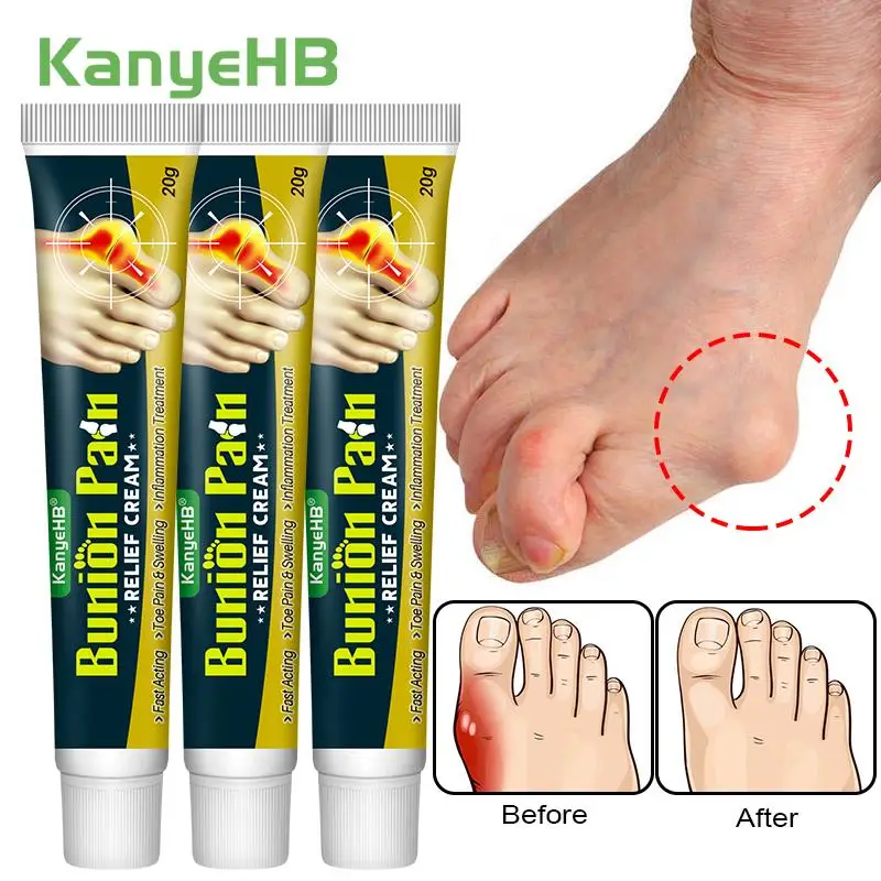 Foot gout treatment cream 3Pcs thumb corrector finger hallux ointment toe bunion pain relieve medical plaster health care A1790