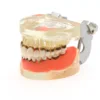 Dental Teeth Model  Dentist Teaching Model Demonstration Periodontal Disease Pathological For Patient Education Demo M4017 3