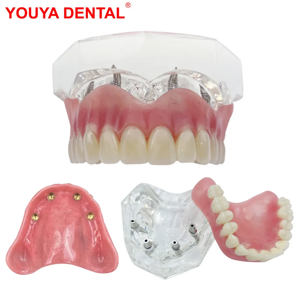 

4 Implants Dental Implant Teeth Model Transparent Overdenture Model With Restoration Bridge For Education Teaching Studying Demo