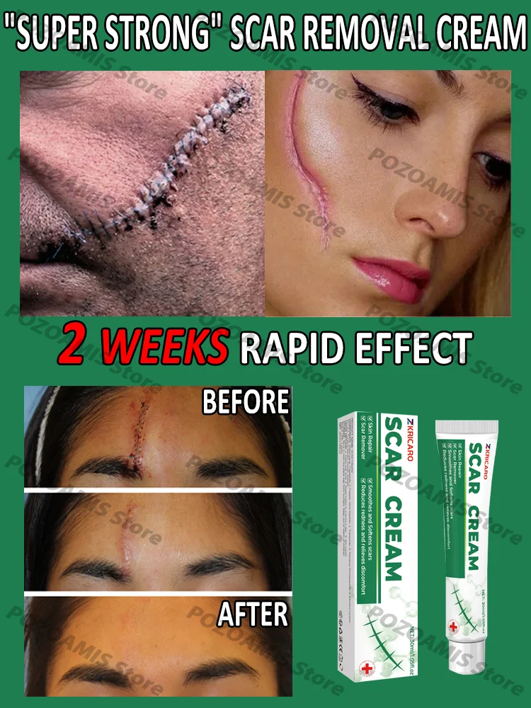 Scar removal, scar removal, burns and cuts, scar hyperplasia