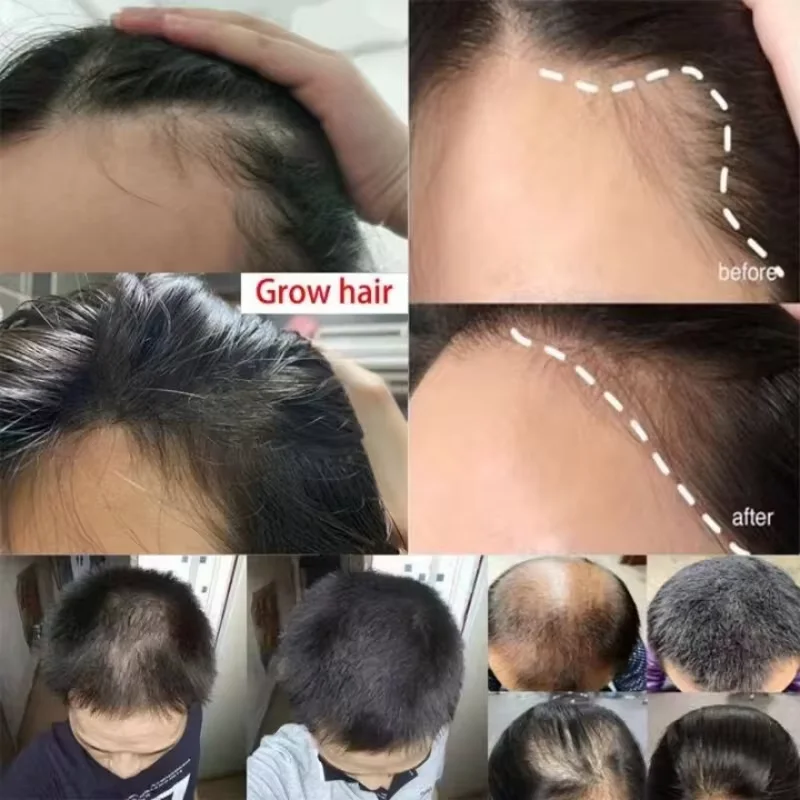 Hair Growth Serum Fast Ginger Hair Growth Spray Anti Hair Loss Regrowth Serum Scalp Damaged Repair Nourish Care for Women Men