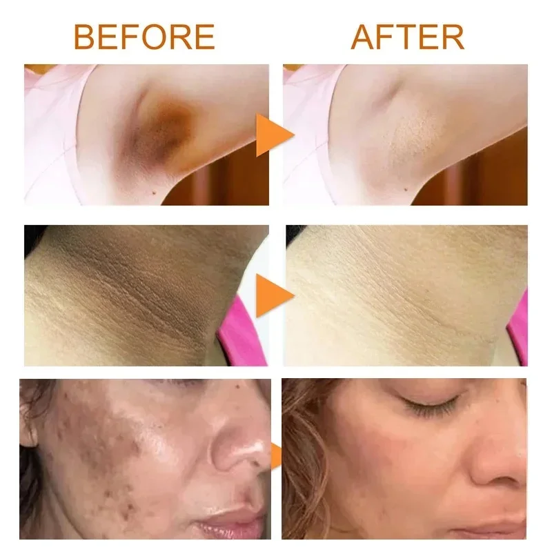 Body Whitening Soap Underarm Knee Bleaching Chicken Skin Removal Dark Spot Removal Dead Skin Moisturize Brighten Body Care body whitening soap