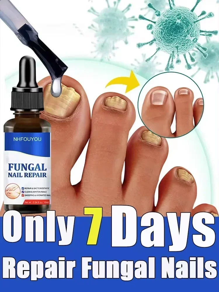 Toenail Nail Fungus Treatment Device for Foot Nail Fungus Essential Oil Onychomycosis Care nail fungus treatment