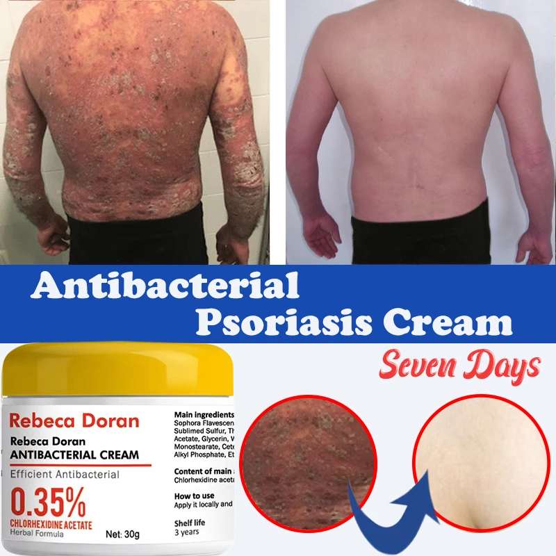 Psoriasis Cream Herbal Antibacterial Antiitch Relief Dermatitis Eczema Treatment Urticaria