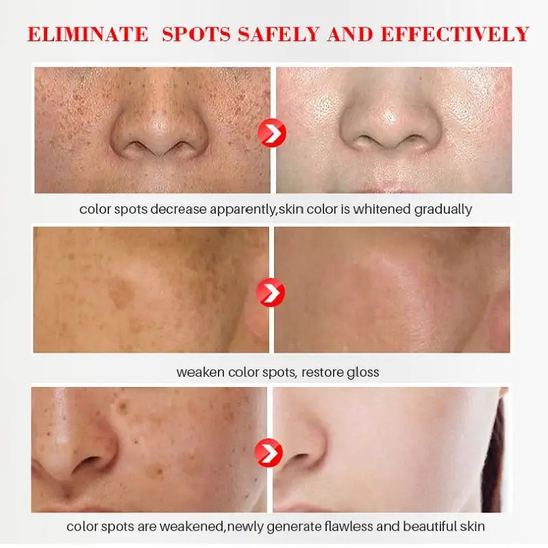 Dimollaure Whitening Freckle Cream Kojic รcido Soro Hidratante Remover Melasma Pigmento Melanina Mancha Escura Iluminar Cuidados Com A Pele