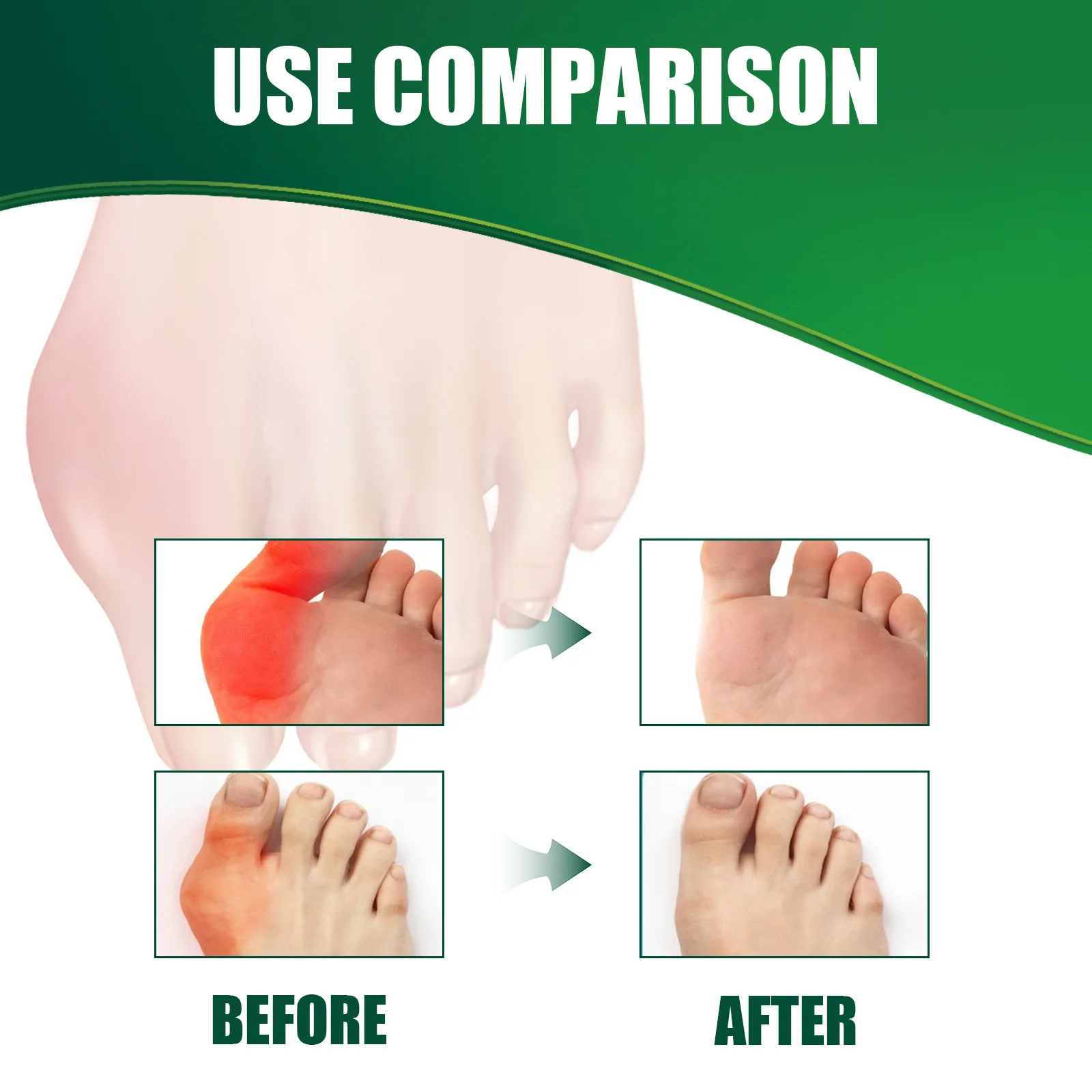 Bunion Analgesic Patch Correct Thumb Joint Gout Treatment Toe Swell Relief Anti Inflammation Hallux Valgus Orthopedic Sticker