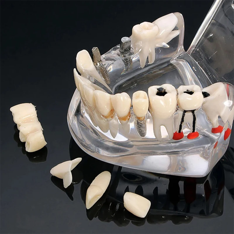 VVDental 치과 질환 치아 모형 치과 질환 교육용 연구 모형 의학용 수복 브릿지 치아 포함