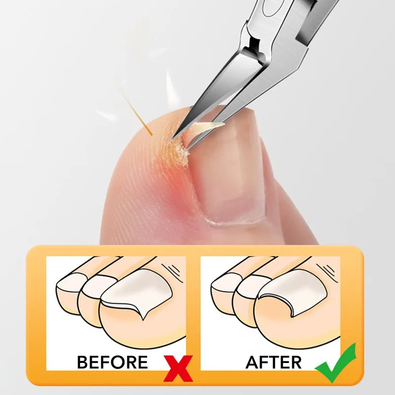 1Pcs Nail Clippers Toenail Cutters Pedicure Manicure Tools Anti-Splash Ingrown Paronychia Professional Correction Tool toe nail clipper nail clipper set nail clipper nail scissors set nail clippers manicure set manicure sets manicure nail clipper set nail clippers kit