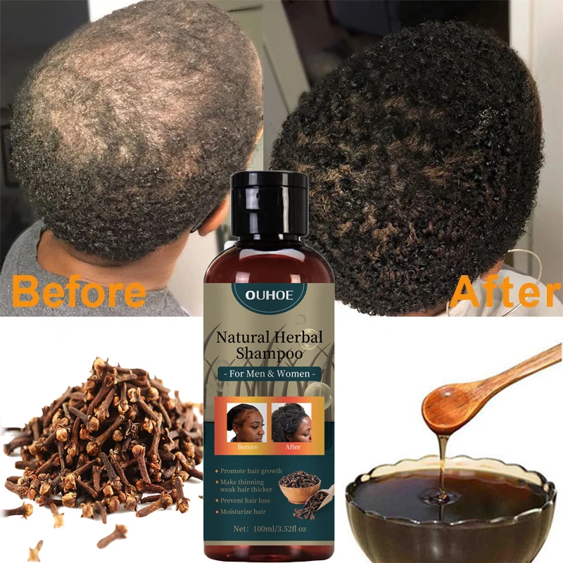 

Africa Women Traction Alopecia Treatment Hair Growth Product for Men Shampoo Hair Loss Treatment Get Rid of Wigs