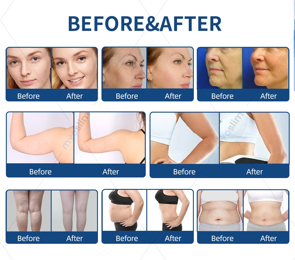 Diodenlaser Körperformung Schlankheits-Lipolyse Laser Fettreduktion Gesichtsstraffung Endo-Lifting Laser Fettabsaugungsgerät – Detail 2