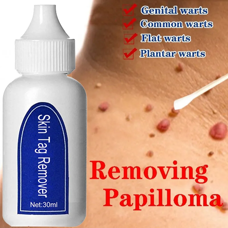 

30ML Skin Tag Remover Genital Wart Treatment Instant Removal Mole&Papillomas Foot Repair Tool Natural Bacteriostatic Liquid
