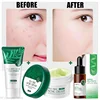 LAIKOU Tea Tree Serum 17ml Anti-Acne Cream 20g Cleanser 50g Plant Extract Refreshing Hydrating Moisturizing Skin Care Set Beauty