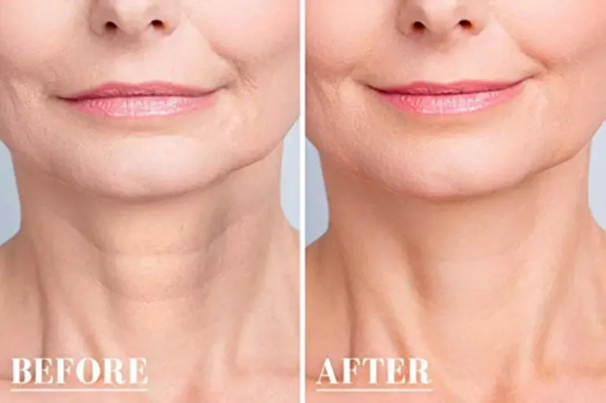 Improved skin texture and youthful lips after aesthetic treatment at Monalisa Store. Professional care for skin and lip enhancement to achieve a natural, vibrant appearance.