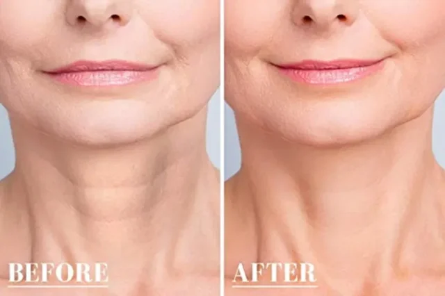 Improved skin texture and youthful lips after aesthetic treatment at Monalisa Store. Professional care for skin and lip enhancement to achieve a natural, vibrant appearance.