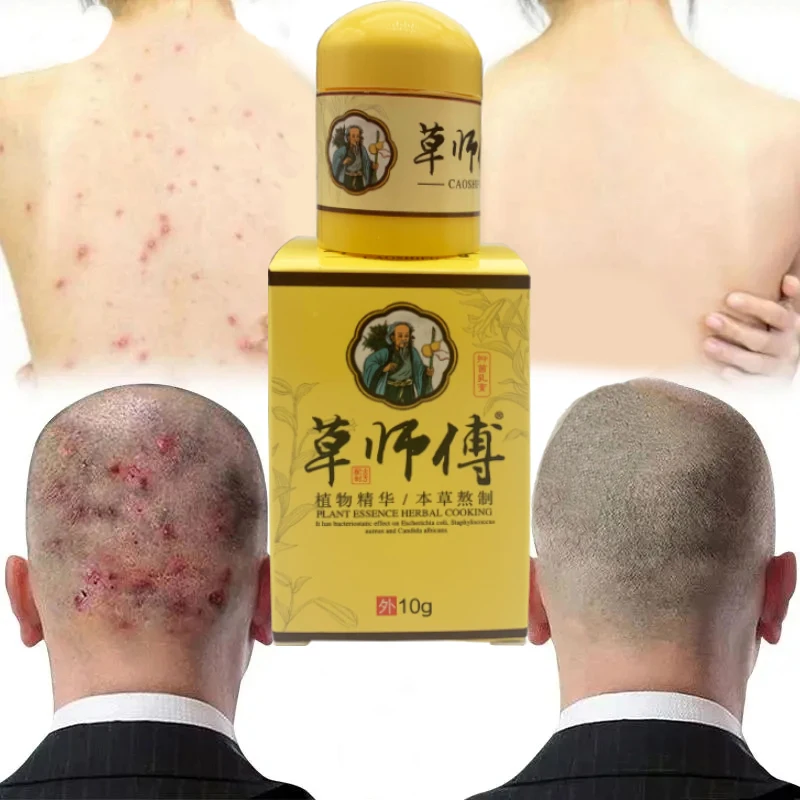 10g ZB Psoriasis cream treating eczema dermatitis antibacterial ointment urticaria natural plant skin itching repair pain relief cream