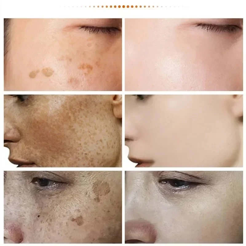 eelhoe Niacinamide Melasma Brightening Cream Reduce Melanin Brighten Cream Lighten Dark Skin Chloasma Serum Fade Fine Face Lines 4