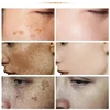 eelhoe Niacinamide Melasma Brightening Cream Reduce Melanin Brighten Cream Lighten Dark Skin Chloasma Serum Fade Fine Face Lines 4
