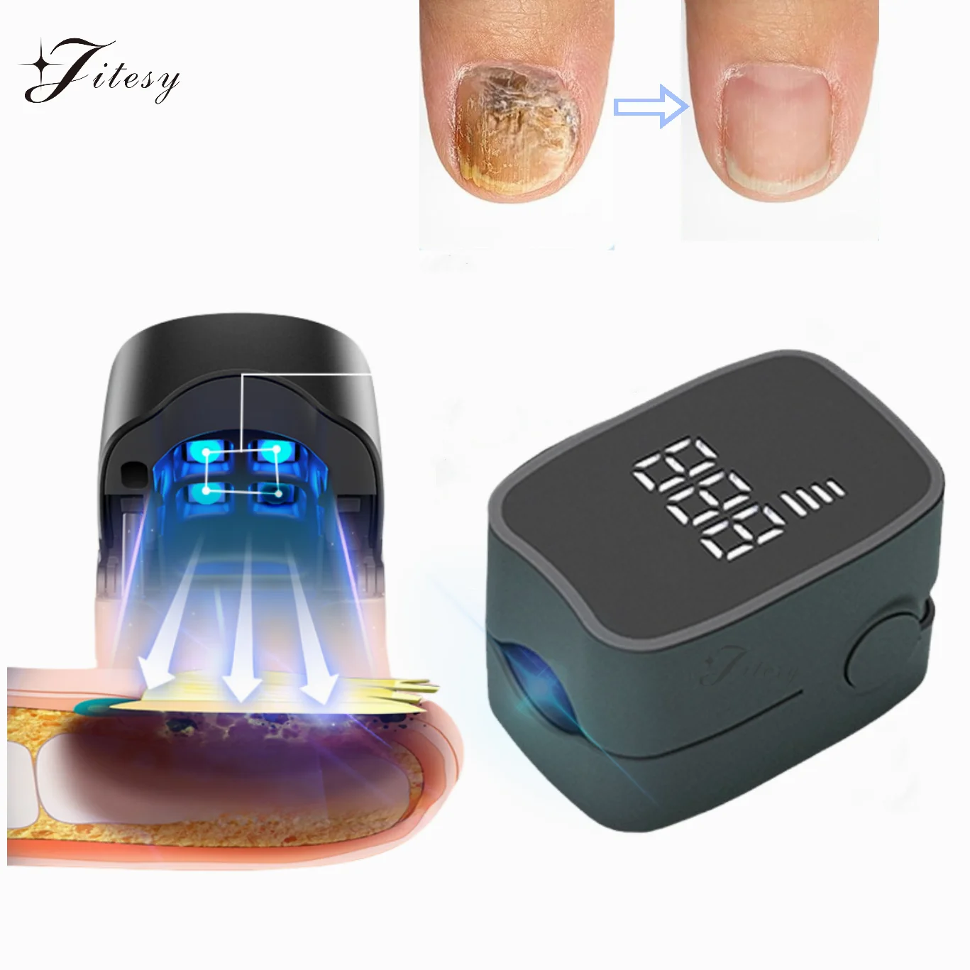 Nail Fungus Remover LED Laser Device Digital Display 905nm Infrared Light 470nm Blue Light For Cleaning Onychomycosis